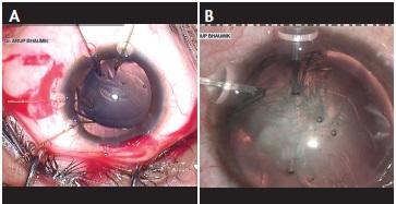 Figure 4. Capsular bag stabilization with Mackool capsular hooks (A) and MicroSurgical Technology capsular hooks (B).