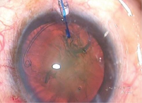 Figure 5. Stabilization of a subluxated lens is accomplished using an Ahmed CTS by hooking the fixation eyelet with an iris hook.