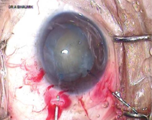 Figure 6. Capsular bag stabilization using a capsular hook placed through a prelimbal incision in a deep anterior chamber.