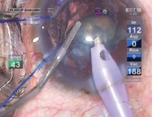 Figure 7. Injection of an OVD with a cannula placed through a second sideport incision.