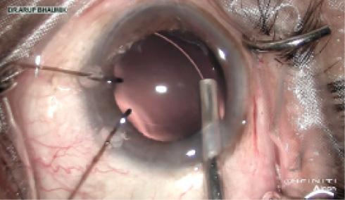 Figure 8. CTR insertion with an injector, maintaining the arc of the capsular bag.