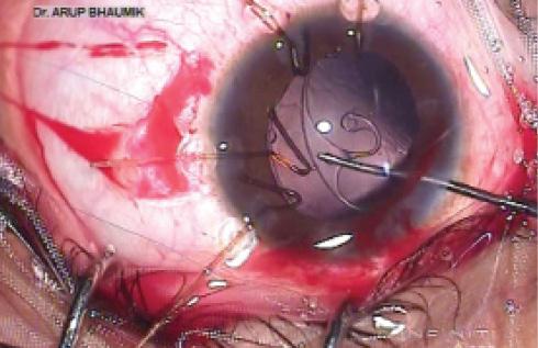 Figure 9. Implantation of an Ahmed CTS at the capsular bag equator with a hook.