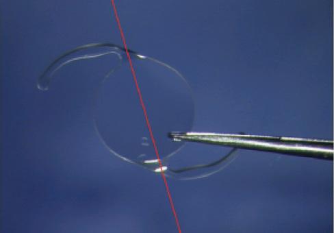 Figure 1. In two-C-loop IOLs, the optic-haptic junctions constitute an axis that allows tilt.