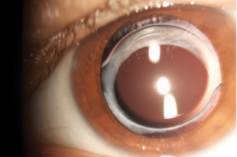 Figure 2. One-year postoperative, tilt of the optic in the capsulorrhexis opening is observed in about one-third of two-C-loop IOLs.