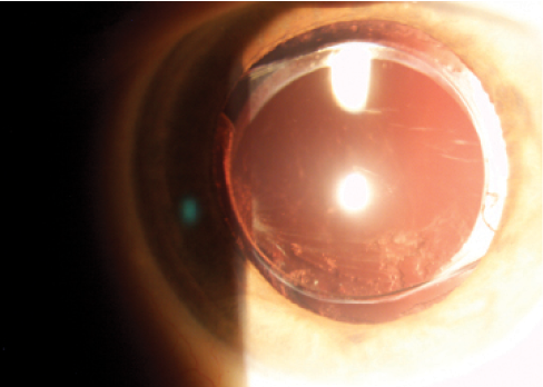Figure 3. Optic tilt facilitates migration of lens epithelial cells and, thus, PCO development.