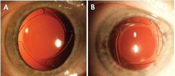 Figure 6. Oval Ring IOL in situ, early postoperative (A) and 1-year postoperative (B).