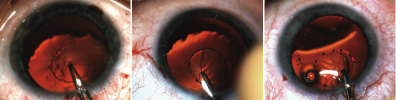 Figure 1. The tag of a laser-assisted capsulotomy is removed in an eye with a dislocated lens.