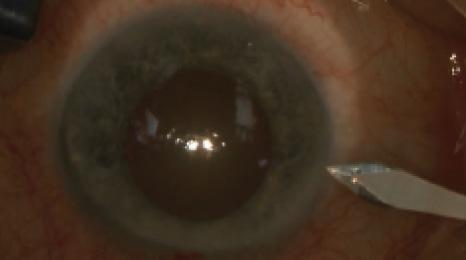 Figure 1. A 1.8-mm incision is created at the steep meridian.