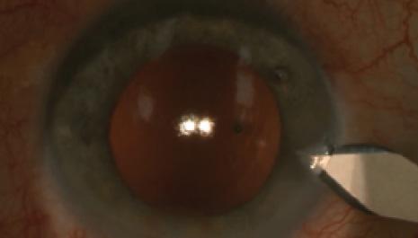 Figure 2. With OVD expanding the anterior chamber and capsular bag, the phaco incision is widened to 2.75 mm.