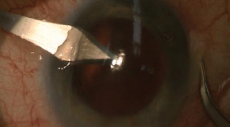 Figure 3. A clear corneal incision of 2.75 mm is made opposite the phaco incision.