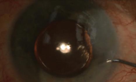 Figure 4. At the end of surgery, only the phaco incision needs hydrating to ensure watertightness.