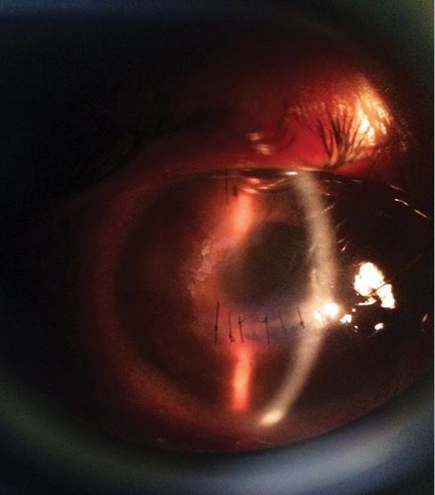 Figure 1. Slit-lamp photograph at 2 days postoperative.
