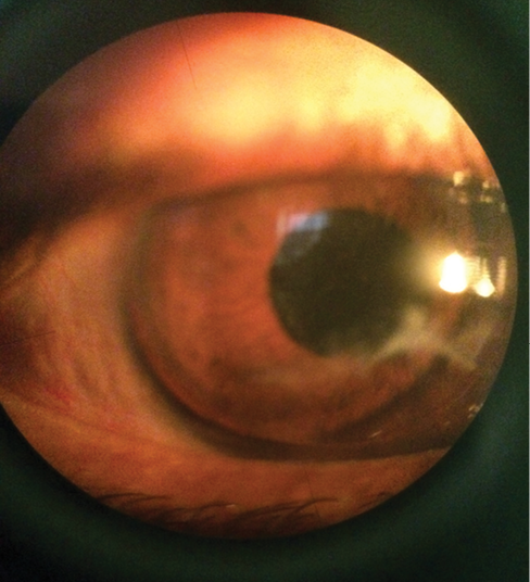 Figure 2. Slit-lamp photograph of the final result after suture
removal, with the patient wearing a rigid contact lens.