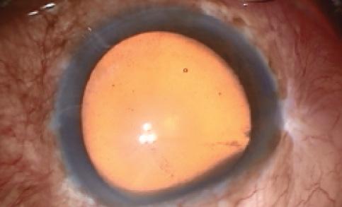 Figure 1. Careful assessment of bleb site is mandatory.