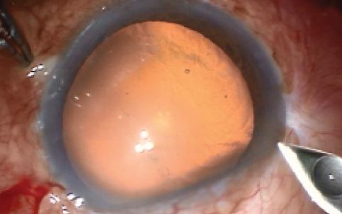 Figure 2. CCI sparing the bleb area.