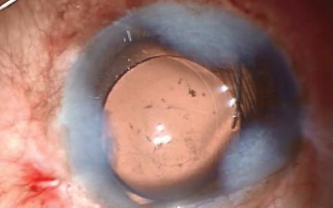Figure 3. Capsular bag placement of the IOL.