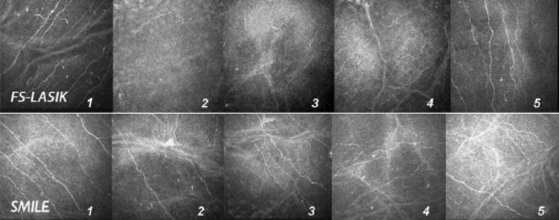 Figure 4. In vivo confocal microscopy images of the central subbasal nerve plexus before and after femto-LASIK (FS-LASIK; top row) and SMILE (bottom row). 1 = preoperative; 2 = 1 week; 3 = 1 month; 4 = 3 months; 5 = 6 months. Note that viable fibers are visible at 1 week and 1 month after surgery in the SMILE group; partial recovery of nerve fiber density starts 3 months after LASIK.