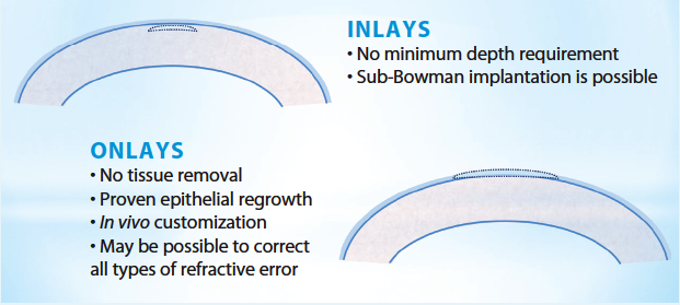 Figure 1. Benefits of allogenic inlays and onlays.