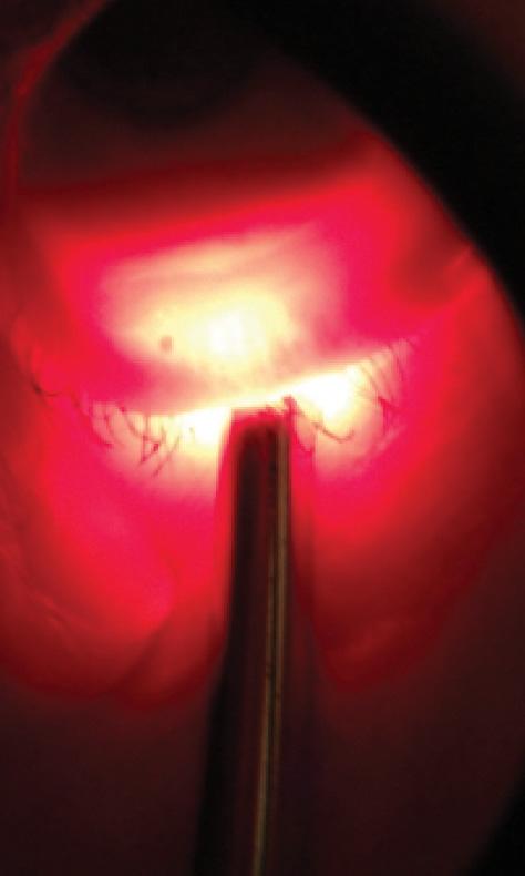 Figure 1. Transillumination of the lower lid. Although it is hard to photograph changes in meibomian gland structure, at the slit lamp it is easy to see gland dropout.
