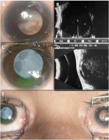 Figure 1. A child with bilateral retinoblastoma associated with cataract in the right eye: Left eye with leucocoria due to large tumor filling the globe and touching the posterior surface of the crystalline lens (A). Ultrasonography of the left eye showing intraocular mass with specks of calcification (B). Right eye showing total opacification of crystalline lens (C). Ultrasonography of the left eye showing intraocular mass with specks of calcification, touching the posterior surface of the crystalline lens (D). External photograph of both eyes revealing cataract in the right eye and leucocoria due to retinoblastoma in the left eye (E).