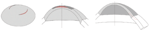 Figure 2. Examples of finite-element models: Simulations of arcuate keratotomy, with the incisions in red (A), of an implant inserted into the cornea, with the implant in red (B), and of a cataract phaco incision, with the incision in red (C). Wherever the model is cut in half, this is for visualization purposes. Full 3-D models are used in all simulations.