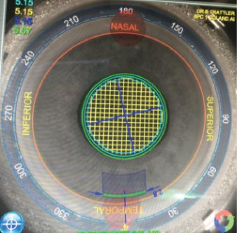 Figure 1. The LACS planning overlay on the Lensar laser. Note the temporal 2.8-mm clear corneal incision (green), the capsulotomy outline (orange), and laser fragmentation pattern (center), as planned in an eye with a small pupil.