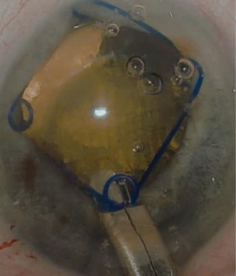 Figure 2. Malyugin Ring placed after femtosecond laser caspulotomy.