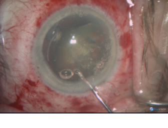 Figure 1. The lens is spun and floated into the anterior chamber in one piece after softening with the femtosecond laser.