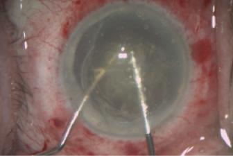 Figure 2. To prepare the lens for aspiration without phaco, the lens is cracked into small pieces mechanically in the anterior chamber using a 180° opposing action.
