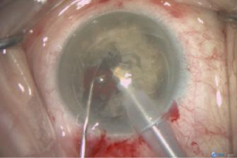 Figure 3. A 1.1-mm diameter phaco tip is used to aspirate the lens fragments without the application of phaco energy. A second instrument is used to guide the fragments.