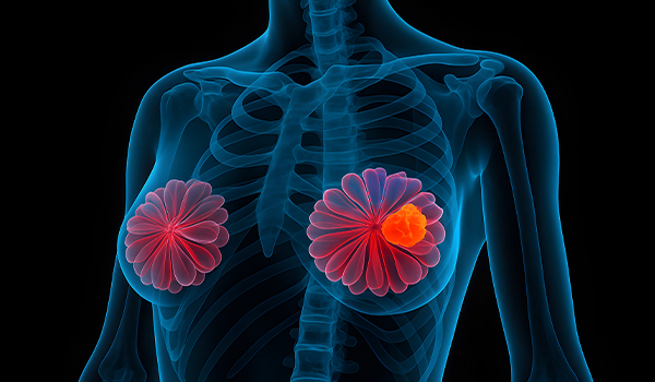 Interdisciplinary Strategies for BRCA-Mutated EBC: Testing, Targeting, and Team-Based Care