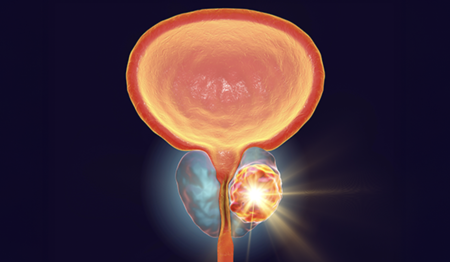 Advancing ADT in HSPC: Interprofessional Intensification Strategies Reshaping Care