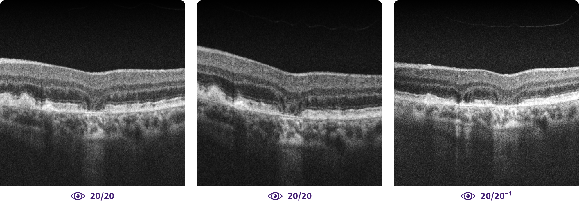 Geographic Atrophy Oct Amd