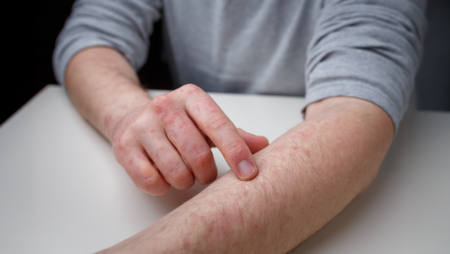 The Neuroimmune Mechanisms Driving Prurigo Nodularis