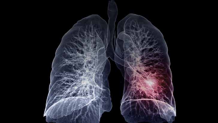 Medical Program: Diagnostic Delays in NTM Lung Disease