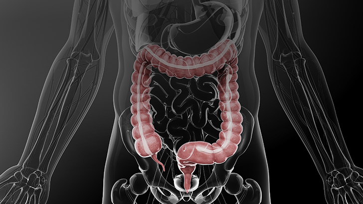 What does the CALM study tell us about Crohn's disease?
