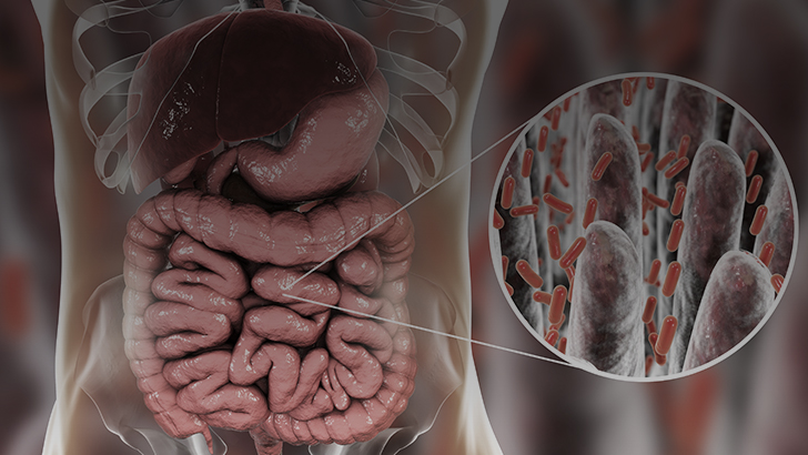 The Complexities Of Small Intestinal Bacterial Overgrowth   12516 Module 