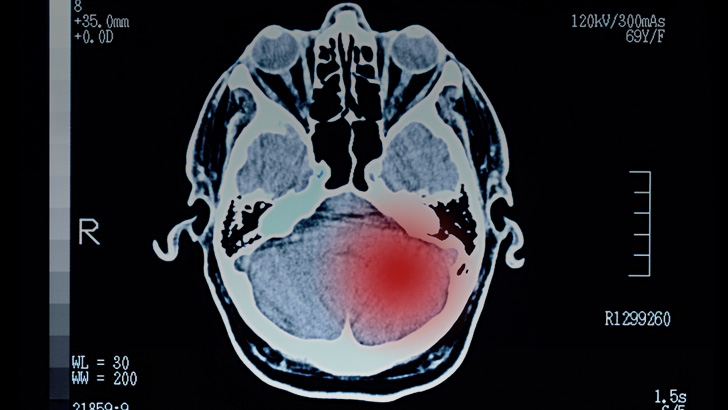 Exploring New Research On Melanoma Brain Metastases Medical Education ...