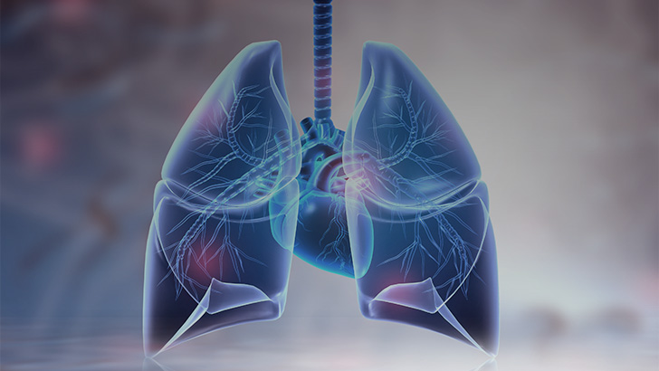 Perspectives on the NTM Guidelines for MAC Lung Disease