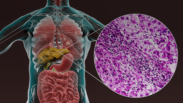 Treatment Strategies for NAFLD: Part 1