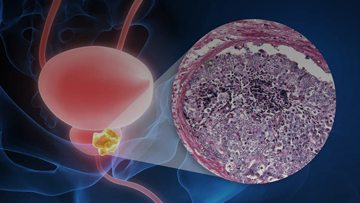 CME: Prostate Cancer: Focusing Androgen Receptor Inhibitors On High ...