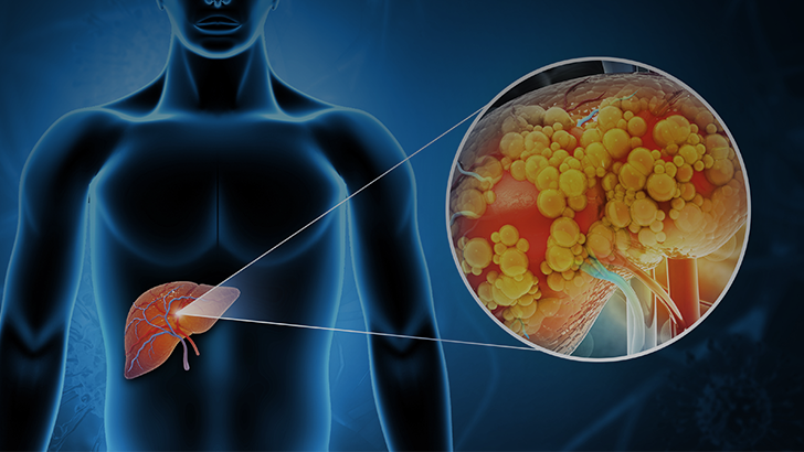 CME; resmetirom, MAESTRO, lanifibranor, fatty liver disease