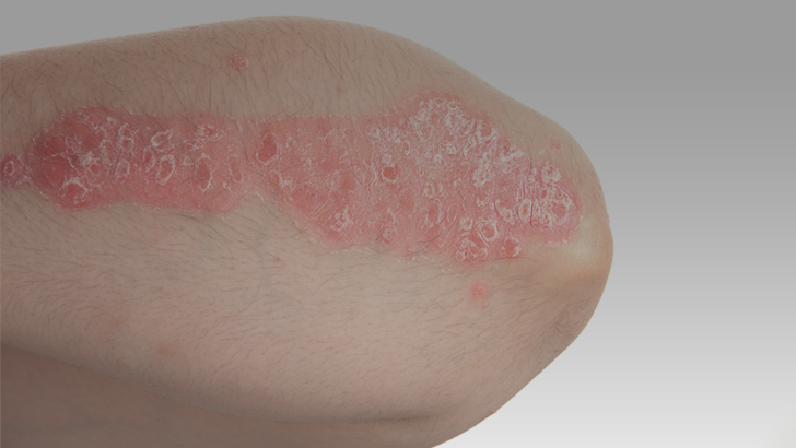 Biosimilars for the Treatment of Psoriasis Medical Education on ReachMD