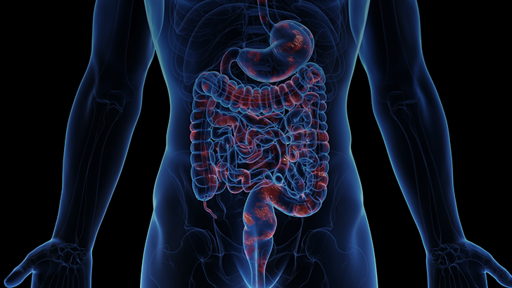 Postoperative Recurrence of Crohn‘s Disease: Reviewing Monitoring and ...