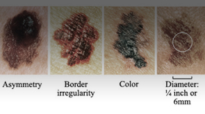 Medical Program: Identifying Melanoma